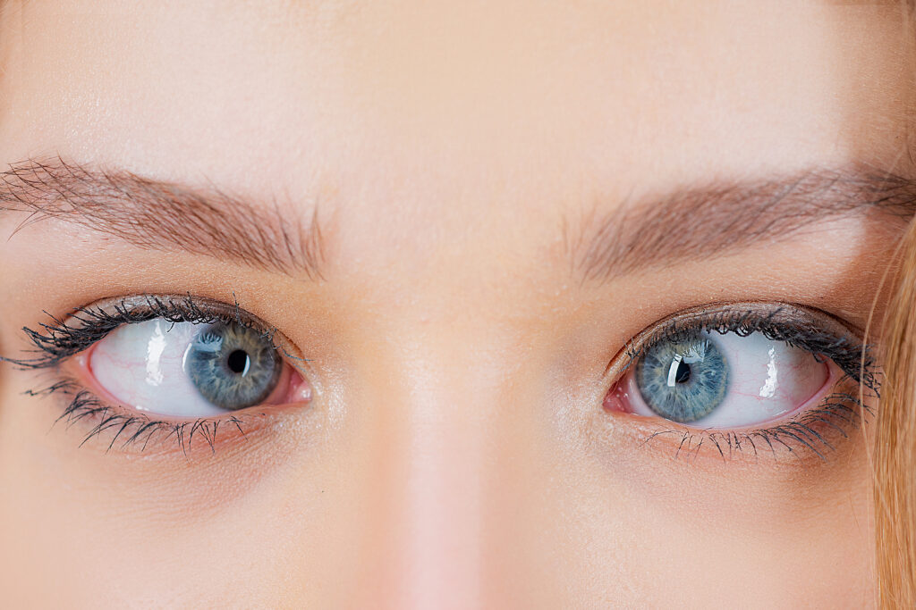 Is Squint Surgery Right for You? A Comprehensive Guide to Decision-Making